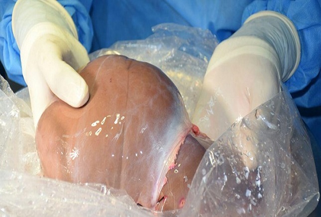 پیوند رایگان کبد در ایران پیوند رایگان کبد در ایران