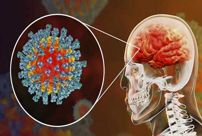  سکته مغزی در مبتلایتان کرونا