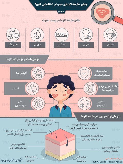 شناسایی عارضه اگزمای صورت/ اینفوگرافی شناسایی عارضه اگزمای صورت/ اینفوگرافی
