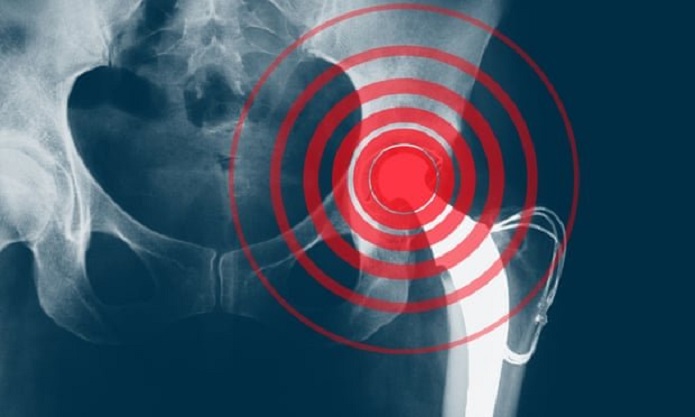  پوکی استخوان 