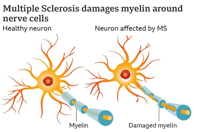 دلیل واقعی بیماری ام اس کشف شد