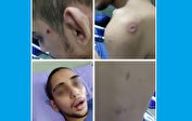 جزئیات شکنجه یک معلول در قائمشهر/ فرزندم را با آثار سوختگی و زخم ترخیص کردم/ بهزیستی: بررسی می‌کنیم