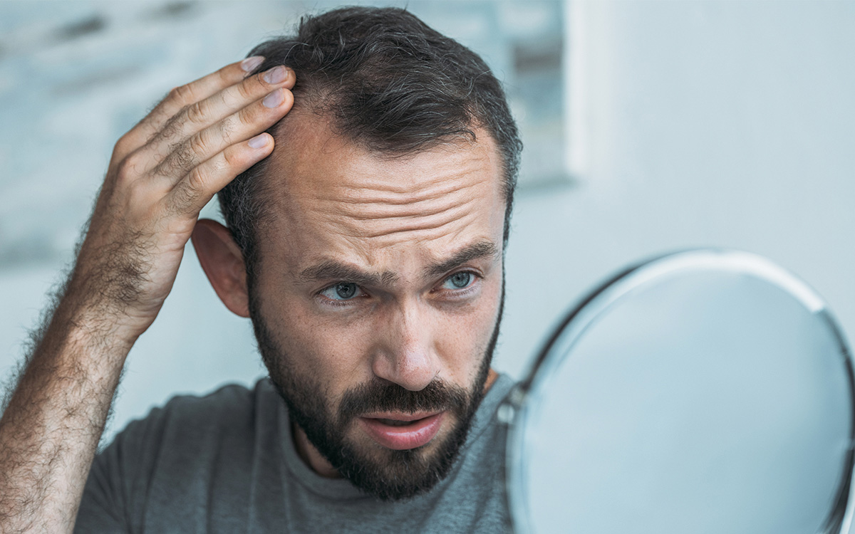 ریزش مو در مرد‌ها و روش‌های درمان آن