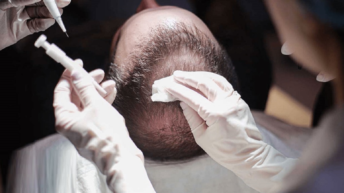 ریزش مو در مرد‌ها و روش‌های درمان آن
