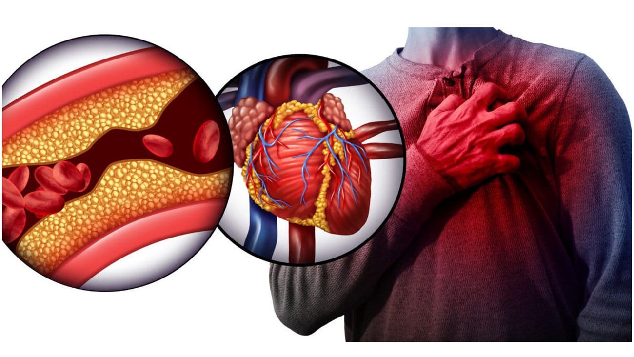 علائم کلسترول بالا و پایین در بدن انسان چیست؟ علائم کلسترول بالا و پایین در بدن انسان چیست؟