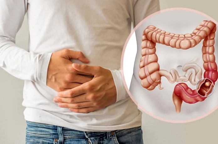علائم اولیه سرطان روده بزرگ چیست؟ علائم اولیه سرطان روده بزرگ چیست؟