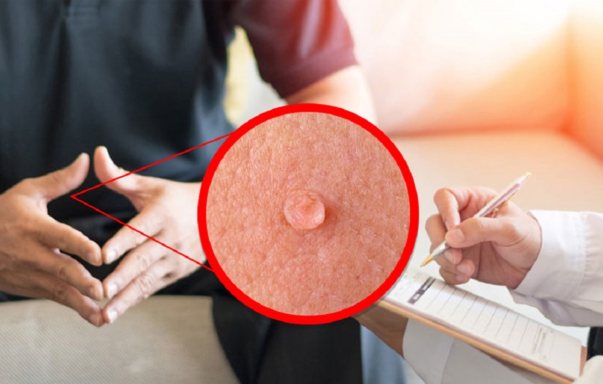 علائم ابتلا به سرطان آلت تناسلی چیست؟ علائم ابتلا به سرطان آلت تناسلی چیست؟