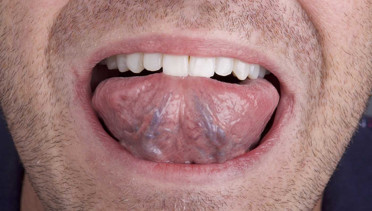 علائم ابتلا به سرطان زبان کدامند؟ علائم ابتلا به سرطان زبان کدامند؟