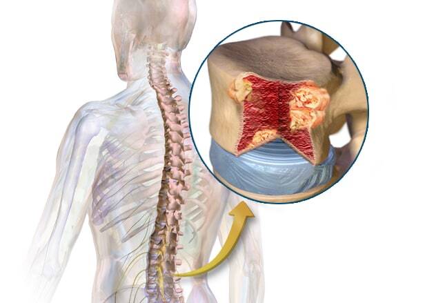 علائم ابتلا به سرطان مغز استخوان علائم ابتلا به سرطان مغز استخوان