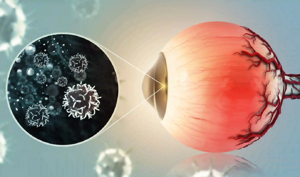علائم ابتلا به سرطان چشم چیست؟ علائم ابتلا به سرطان چشم چیست؟