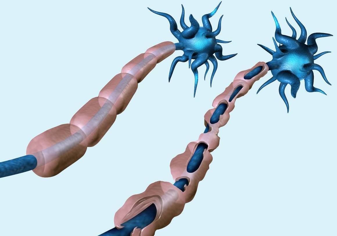 بیماری‌ ام اس چیست و راه‌های درمان آن کدامند؟