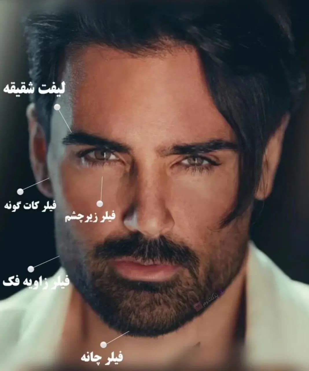 عکس/ تغییر چهره باورنکردنی سهراب پاکزاد بعد از عمل زیبایی!