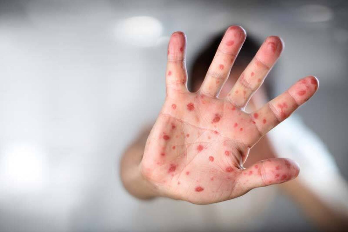 همه آنچه باید درباره آبله مرغان بدانیم همه آنچه باید درباره آبله مرغان بدانیم