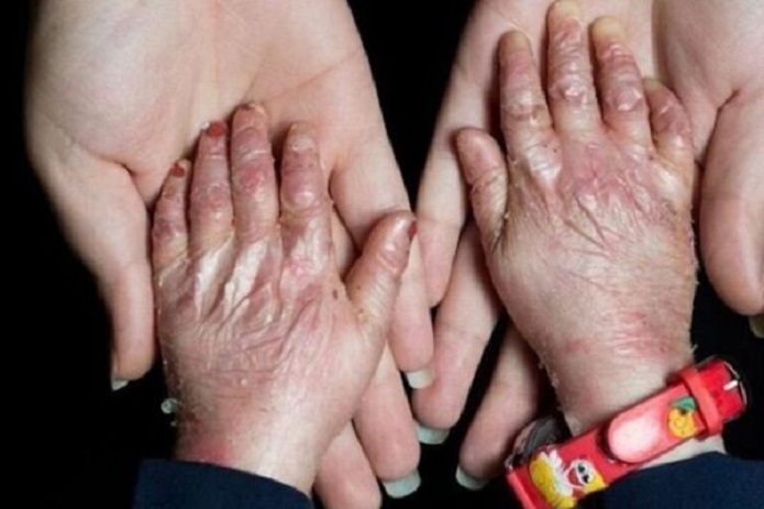 همه آنچه باید درباره بیماری EB بدانیم