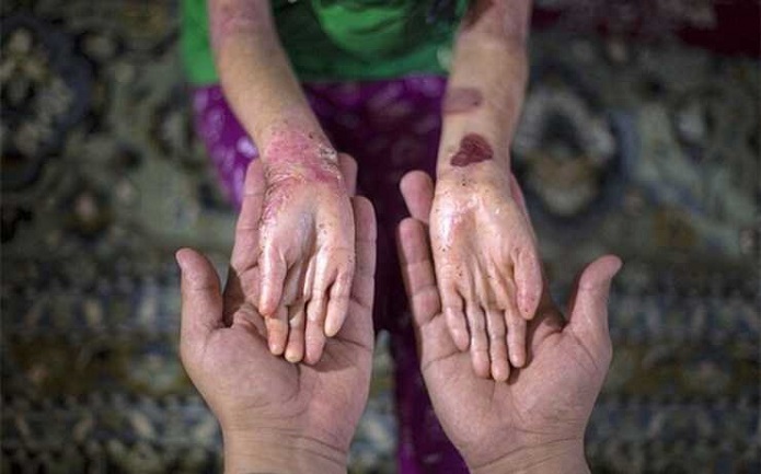 همه آنچه باید درباره بیماری EB بدانیم