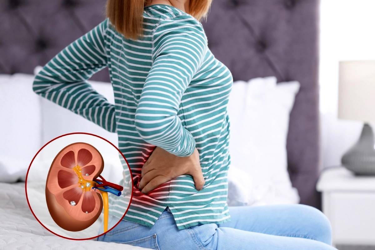 علائم و نشانههای سنگ کلیه چیست؟ علائم و نشانههای سنگ کلیه چیست؟