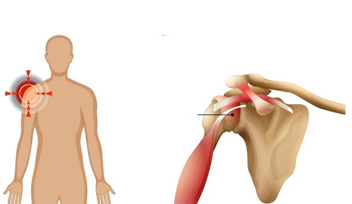 بیماری کپسولیت چسبنده یا شانه منجمد چیست؟