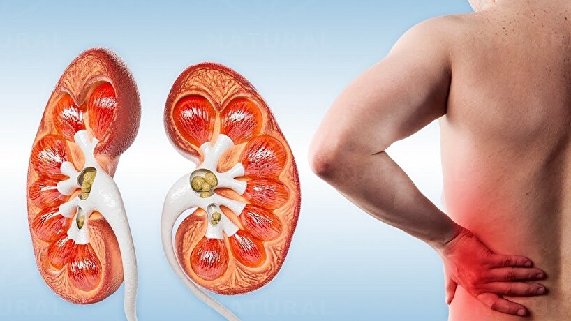 علائم و نشانه‌های سنگ کلیه چیست؟