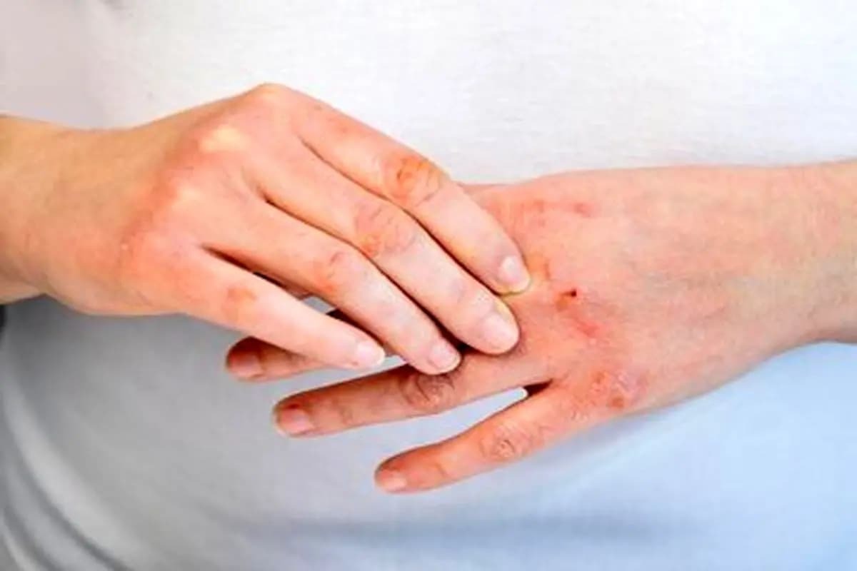 چطور اگزما رو مهار کنیم؟