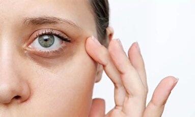 ۶ راه‌ حل برای از بین بردن پف و تیرگی زیر چشم