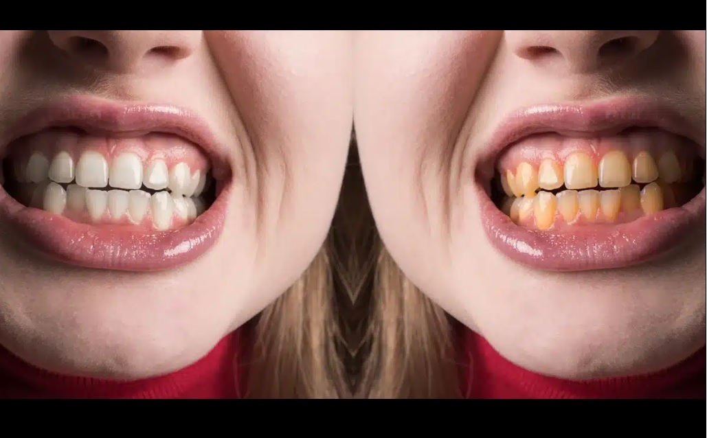 راه‌های سفید کردن دندان