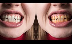 علل زردی دندان و راهکار‌های خانگی و حرفه‌ای سفیدی آن