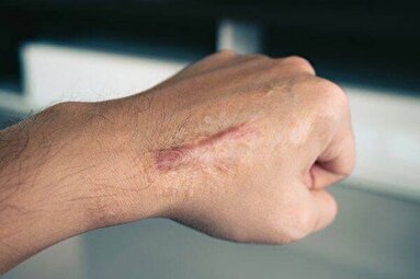 علت کلوئید و راه‌های درمان آن چیست؟