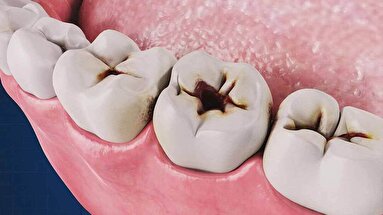 چگونه از پوسیدگی دندان جلوگیری کنیم؟