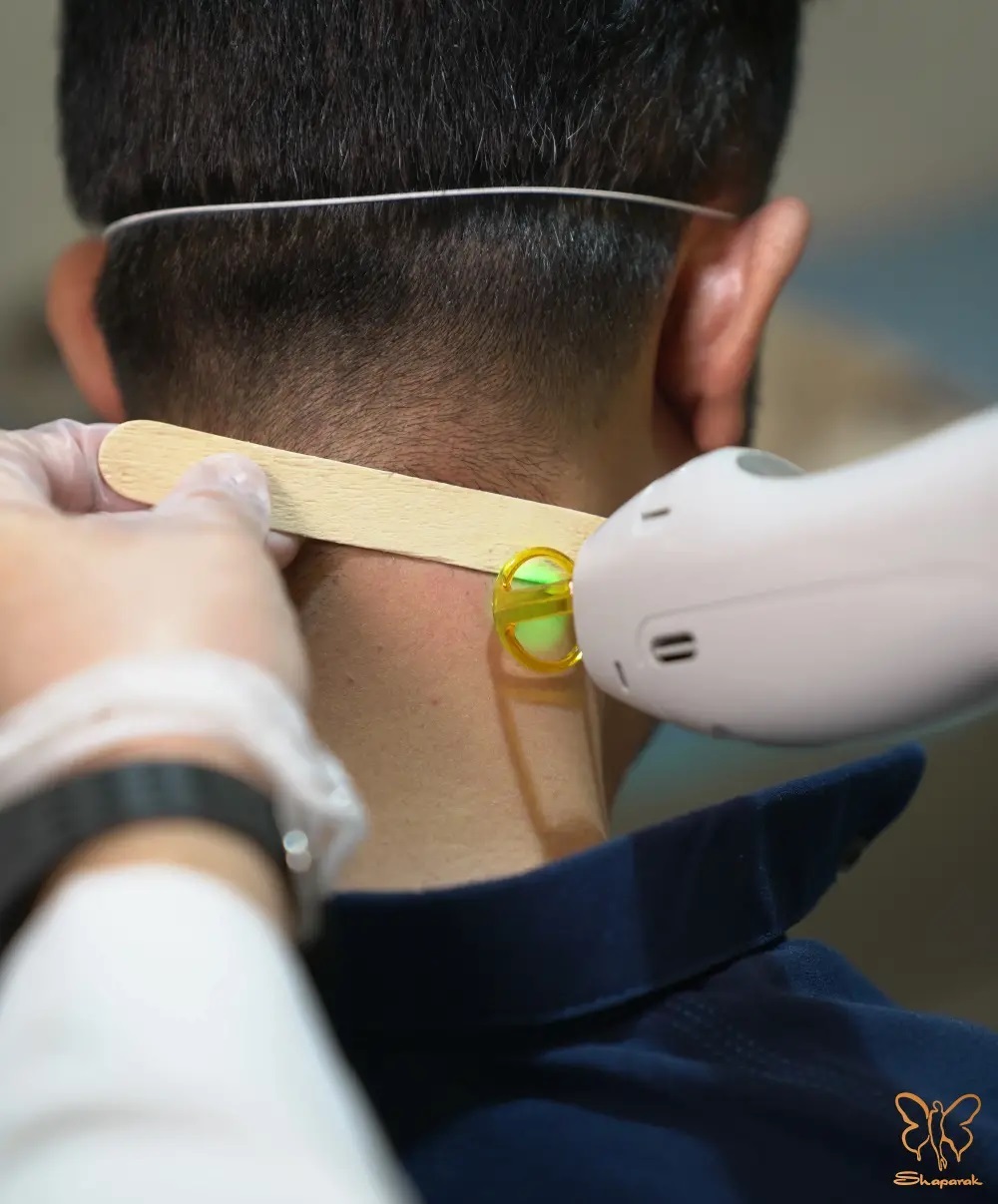 لیزر موهای زائد در مشهد